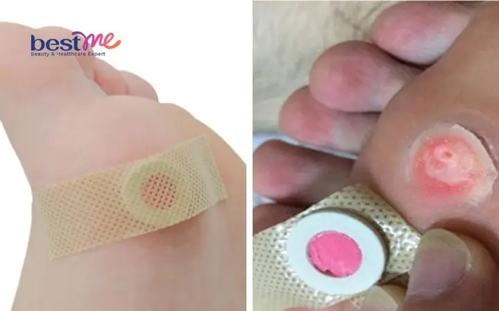 Miếng Dán Trị Mụn Có Tốt Không? Đánh Giá Hiệu Quả & Cách Dùng Đúng