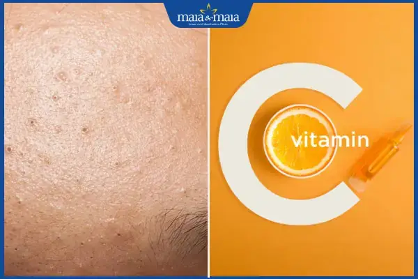 Mụn Ẩn Có Nên Dùng Vitamin C Không? Hướng Dẫn Sử Dụng An Toàn, Hiệu Quả Mụn Ẩn Có Nên Dùng Vitamin C Không? Hướng Dẫn Sử Dụng An Toàn, Hiệu Quả