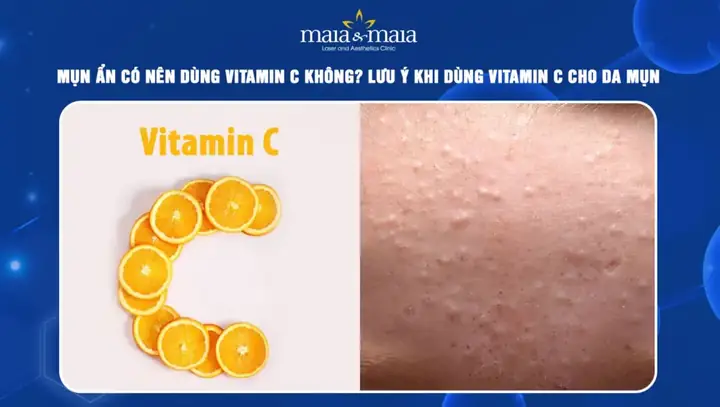 Mụn Ẩn Có Nên Dùng Vitamin C Không? Hướng Dẫn Sử Dụng An Toàn, Hiệu Quả Mụn Ẩn Có Nên Dùng Vitamin C Không? Hướng Dẫn Sử Dụng An Toàn, Hiệu Quả