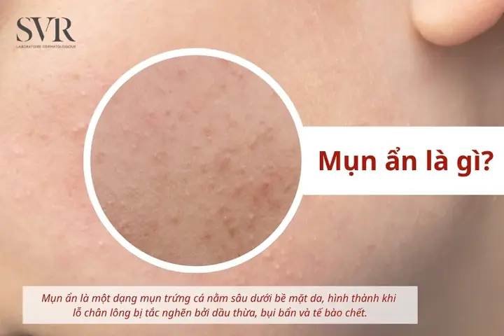 Mụn Ẩn Dưới Da Có Tự Hết Không? Bao Lâu & Cách Xử Lý Hiệu Quả Mụn Ẩn Dưới Da Có Tự Hết Không? Bao Lâu & Cách Xử Lý Hiệu Quả