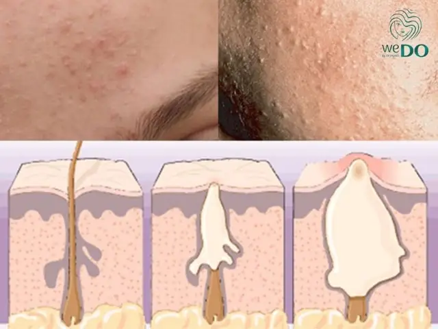 Mụn Ẩn Dưới Da Có Tự Hết Không? Bao Lâu & Cách Xử Lý Hiệu Quả Mụn Ẩn Dưới Da Có Tự Hết Không? Bao Lâu & Cách Xử Lý Hiệu Quả
