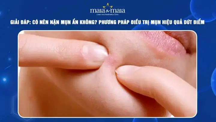 Mụn Ẩn Trồi Lên Có Nên Nặn Không? Khi Nào Là Thời Điểm Vàng?