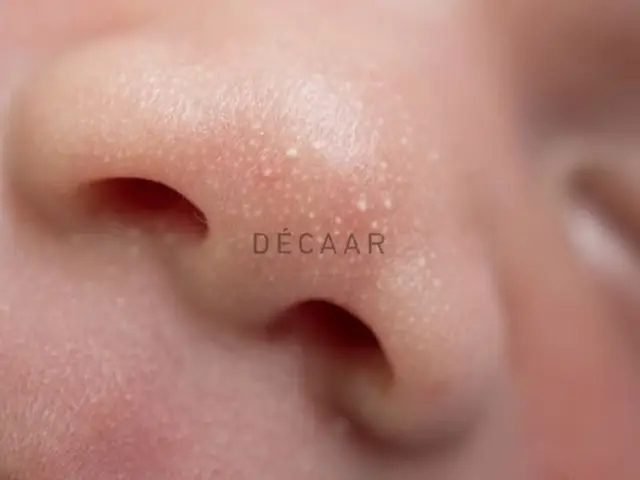 Mụn Sữa Ở Đầu Trẻ Sơ Sinh: Nguyên Nhân, Cách Nhận Biết & Phương Pháp Xử Lý An Toàn