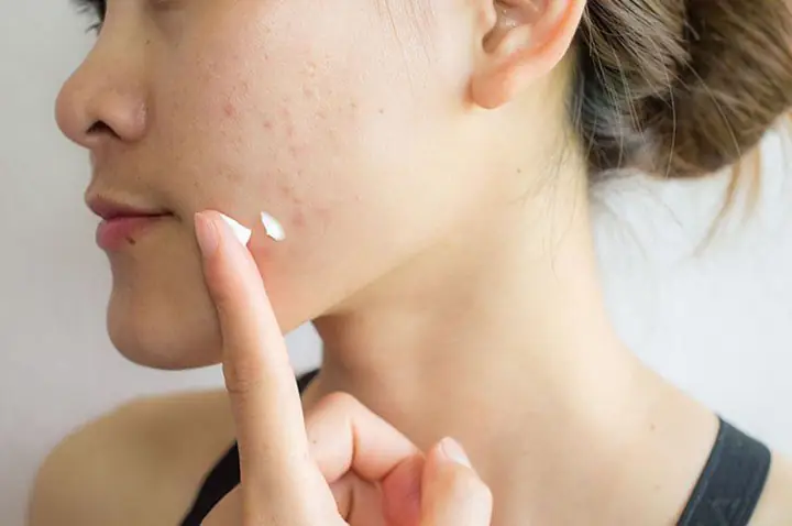 Bao Lâu Nên Bôi Thuốc Trị Mụn Lại? Khi Nào Cần Đợi Và Khi Nào Cần Rửa Mặt?