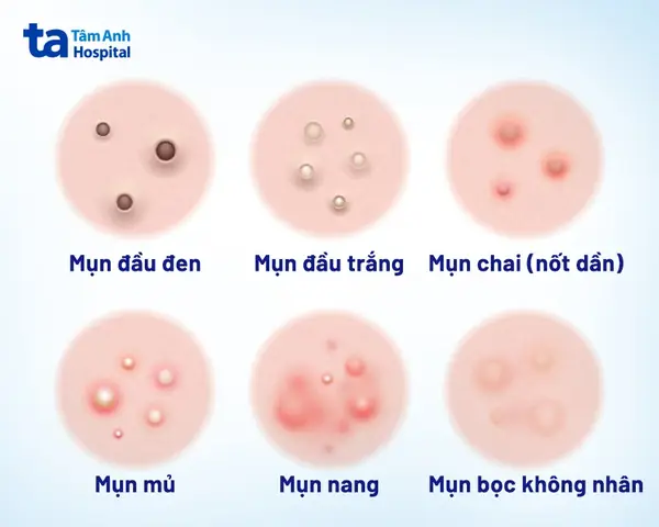 Khi Nào Nên Nặn Mụn? Hướng Dẫn Chi Tiết Và Thời Điểm Lý Tưởng Tránh Tổn Thương Da