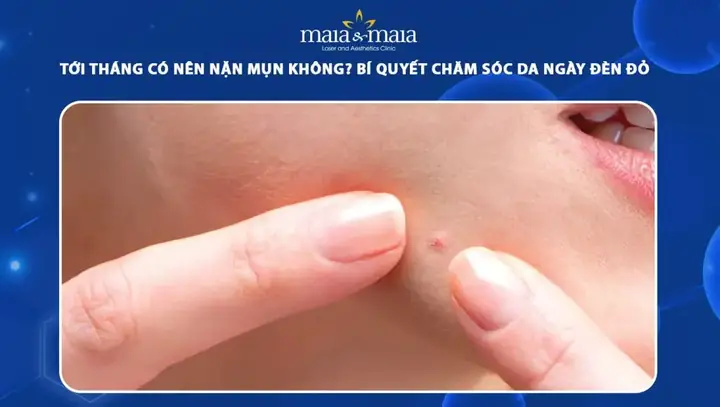 Thời Điểm Vàng Để Nặn Mụn: Khi Nào Nên Nặn Và Cách Nặn Đúng Chuẩn, Tránh Thâm Sẹo Thời Điểm Vàng Để Nặn Mụn: Khi Nào Nên Nặn Và Cách Nặn Đúng Chuẩn, Tránh Thâm Sẹo