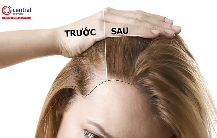 Giải Pháp Toàn Diện: Ngăn Rụng Tóc & Kích Thích Mọc Tóc Nhanh Chóng, An Toàn Tại Nhà