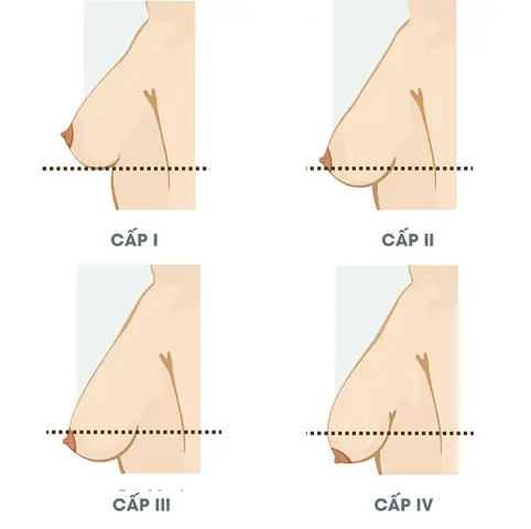 Thay Đổi Của Ngực Phụ Nữ Sau Khi Cho Con Bú Và Cách Chăm Sóc Hiệu Quả