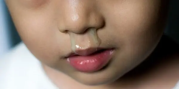Bé Bị Sổ Mũi: Nguyên Nhân Phổ Biến, Triệu Chứng Và Cách Xử Lý Hiệu Quả