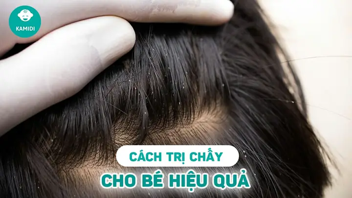 Cách Trị Chấy Tại Nhà An Toàn, Hiệu Quả & Dứt Điểm Cho Mọi Lứa Tuổi