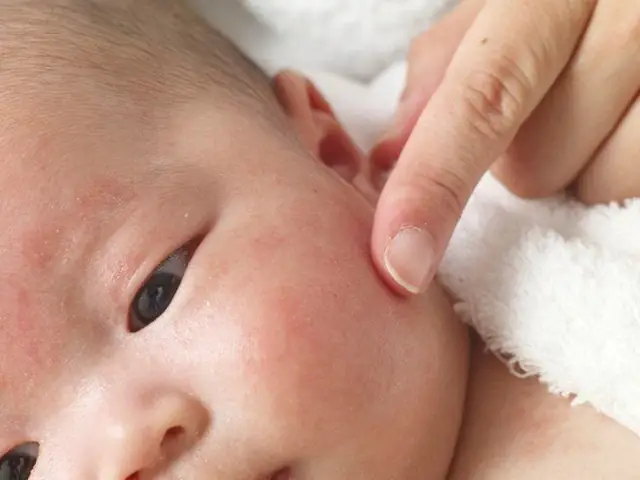 Trẻ Nổi Mẩn Đỏ Trên Mặt: Nguyên Nhân, Cách Xử Lý Và Phòng Ngừa Hiệu Quả
