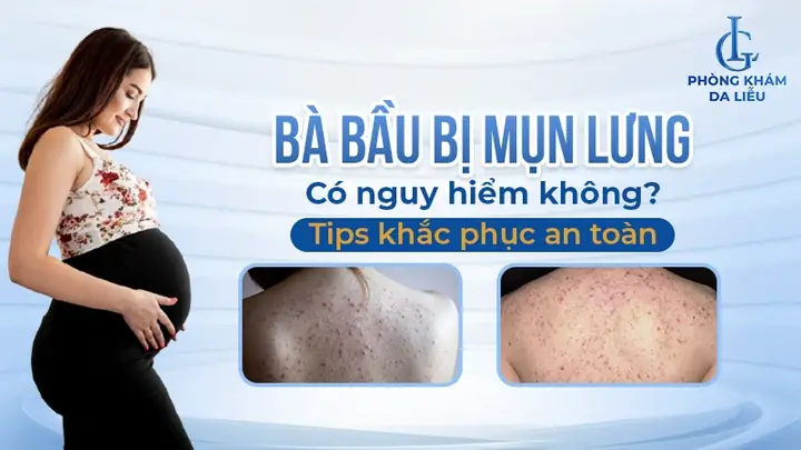 Nổi Mụn Lưng Bụng Khi Mang Thai: Nguyên Nhân, Dấu Hiệu & Cách Xử Lý An Toàn Nổi Mụn Lưng Bụng Khi Mang Thai: Nguyên Nhân, Dấu Hiệu & Cách Xử Lý An Toàn