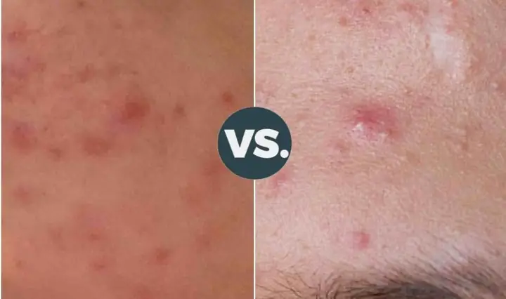 Đẩy Mụn Ẩn Bao Lâu Thì Hết? Giải Đáp Toàn Diện & Cách Xử Lý Hiệu Quả Đẩy Mụn Ẩn Bao Lâu Thì Hết? Giải Đáp Toàn Diện & Cách Xử Lý Hiệu Quả