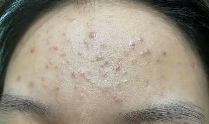 Đẩy Mụn Ẩn Bao Lâu Thì Hết? Giải Đáp Toàn Diện & Cách Xử Lý Hiệu Quả Đẩy Mụn Ẩn Bao Lâu Thì Hết? Giải Đáp Toàn Diện & Cách Xử Lý Hiệu Quả