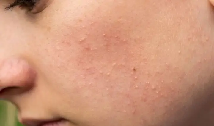 Đẩy Mụn Ẩn Bao Lâu Thì Hết? Giải Đáp Toàn Diện & Cách Xử Lý Hiệu Quả Đẩy Mụn Ẩn Bao Lâu Thì Hết? Giải Đáp Toàn Diện & Cách Xử Lý Hiệu Quả