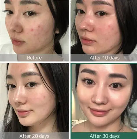 Review Set Mini Trị Mụn Some By Mi: Có Nên Mua Không? Review Set Mini Trị Mụn Some By Mi: Có Nên Mua Không?