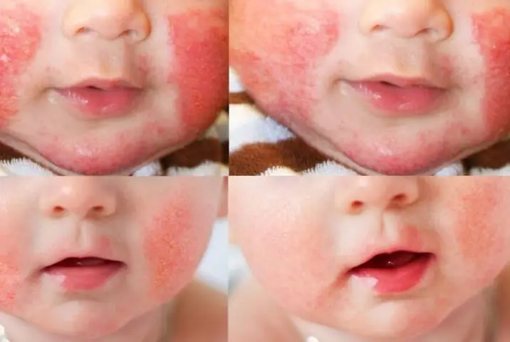 Trẻ Bị Nổi Mẩn Đỏ Trên Mặt: Nguyên Nhân, Cách Nhận Biết Và Xử Trí An Toàn Cho Bé Trẻ Bị Nổi Mẩn Đỏ Trên Mặt: Nguyên Nhân, Cách Nhận Biết Và Xử Trí An Toàn Cho Bé
