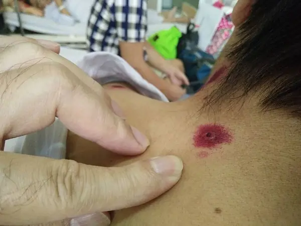 Trẻ Em Bị Ong Vò Vẽ Đốt: Dấu Hiệu, Cách Xử Lý Cấp Cứu Và Phòng Ngừa Nguy Hiểm
