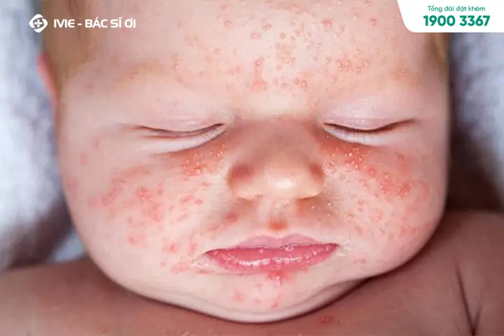 Trẻ Sơ Sinh Bị Khô Da Mặt & Mẩn Đỏ: Nguyên Nhân, Dấu Hiệu Và Cách Xử Lý Hiệu Quả
