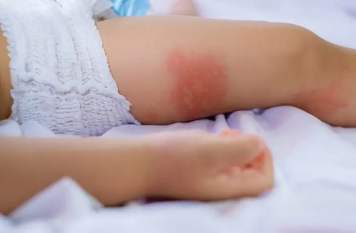 Trẻ Sơ Sinh Bị Muỗi Cắn: Cách Xử Lý & Phòng Ngừa An Toàn Cho Bé
