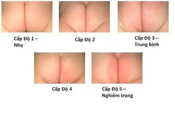 Cách Trị Hăm Tã Cho Trẻ Sơ Sinh Tại Nhà An Toàn, Hiệu Quả Nhất