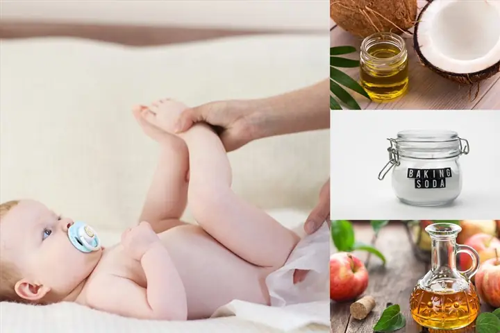 Cách Trị Hăm Tã Cho Trẻ Sơ Sinh Tại Nhà An Toàn, Hiệu Quả Nhất