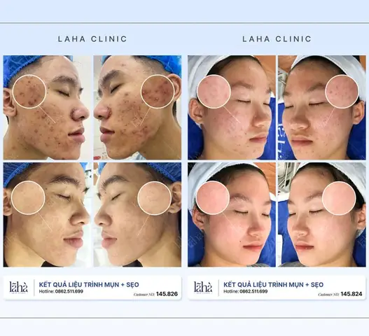 Trị Mụn Ở Đâu Tốt Nhất Hà Nội: Top Phòng Khám, Bệnh Viện Uy Tín