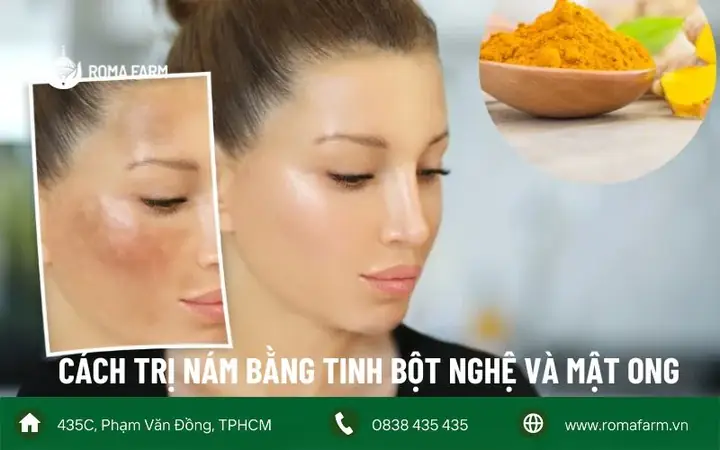 Trị Nám Bằng Mật Ong Và Nghệ: Công Thức Hiệu Quả Tại Nhà Mà Bạn Cần Biết