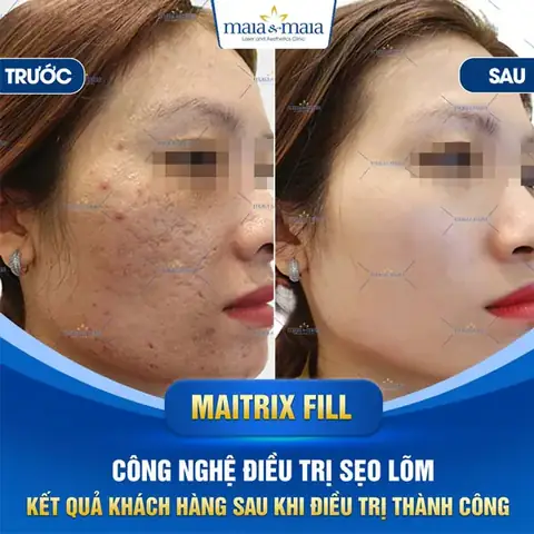 Trị Sẹo Rỗ Tự Nhiên: Bí Quyết An Toàn Và Hiệu Quả Cho Làn Da Mịn Màng