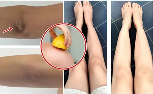 9+ Cách Trị Thâm Đầu Gối Nhanh Nhất Tại Nhà: Bí Quyết Da Mịn Màng, Sáng Màu