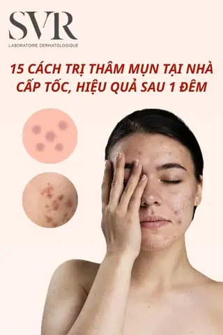 Trị Thâm Sau Mụn Tại Nhà: Bí Quyết Hiệu Quả Từ Thiên Nhiên & Khoa Học