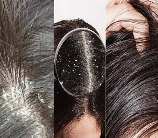 Tại Sao Gội Đầu Xong Vẫn Có Gàu? Nguyên Nhân Và Cách Khắc Phục Tận Gốc Tại Sao Gội Đầu Xong Vẫn Có Gàu? Nguyên Nhân Và Cách Khắc Phục Tận Gốc