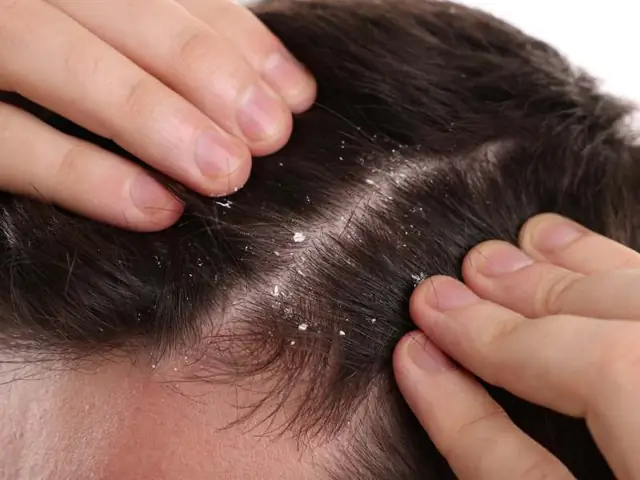Tại Sao Gội Đầu Xong Vẫn Có Gàu? Nguyên Nhân Và Cách Khắc Phục Tận Gốc Tại Sao Gội Đầu Xong Vẫn Có Gàu? Nguyên Nhân Và Cách Khắc Phục Tận Gốc