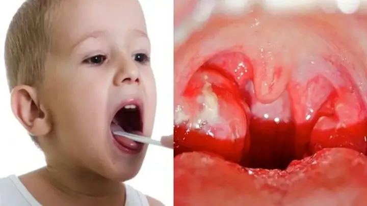 Xông Mũi Cho Bé Bằng Nước Muối Sinh Lý: Hướng Dẫn Chi Tiết Và Những Điều Cần Biết Xông Mũi Cho Bé Bằng Nước Muối Sinh Lý: Hướng Dẫn Chi Tiết Và Những Điều Cần Biết